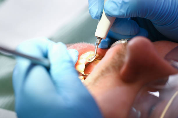 Best Emergency Tooth Extraction in Sylacauga, AL